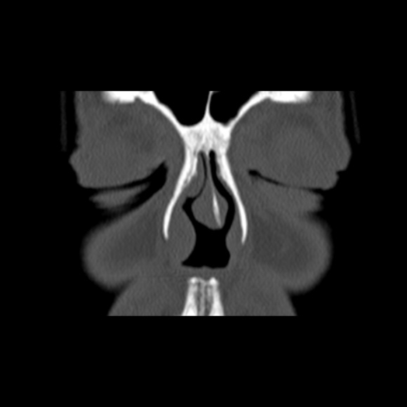 File:Nasal septal perforation (Radiopaedia 25030-25289 Coronal bone window 14).jpg