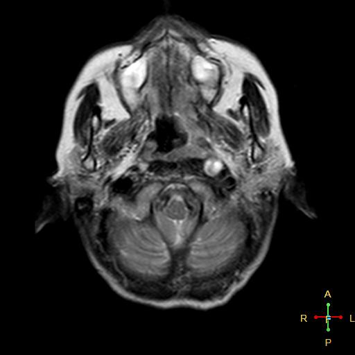 File:Nasopharyngeal carcinoma infiltrating the clivus (Radiopaedia 25229-25481 Axial T2 3).jpg