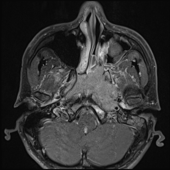 Nasopharyngeal carcinoma with skull base invasion (Radiopaedia 53415-59485 Axial T1 C+ fat sat 25).jpg