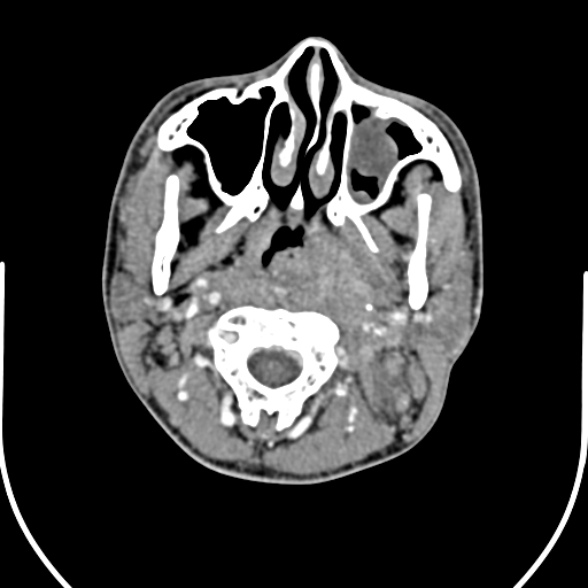 Nasopharyngeal carcinoma with skull base invasion (Radiopaedia 53415-59705 A 63).jpg