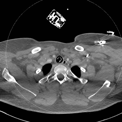 Neck CT angiogram (intraosseous vascular access) (Radiopaedia 55481-61945 B 100).jpg