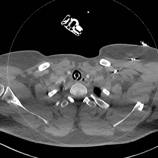 Neck CT angiogram (intraosseous vascular access) (Radiopaedia 55481-61945 B 105).jpg