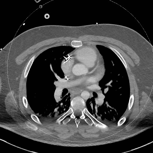 File:Neck CT angiogram (intraosseous vascular access) (Radiopaedia 55481-61945 B 12).jpg