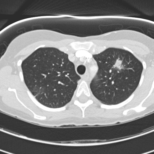 Necrobiotic pulmonary nodules - Crohn disease (Radiopaedia 20723-20631 Axial lung window 37).jpg