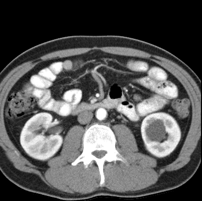 File:Necrotizing pancreatitis with acute necrotic collection (Radiopaedia 14470-14417 B 24).jpg
