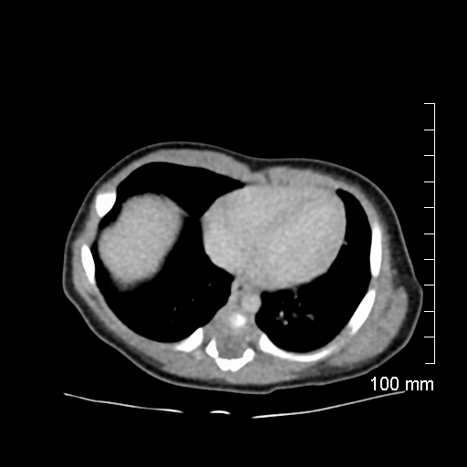 File:Neonatal neuroblastoma (Radiopaedia 56651-63438 Axial non-contrast 9).jpg