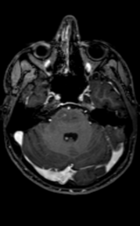 Neuro-Behçet disease (Radiopaedia 90112-107294 Axial T1 C+ 165).jpg