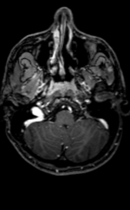 Neuro-Behçet disease (Radiopaedia 90112-107294 Axial T1 C+ 181).jpg