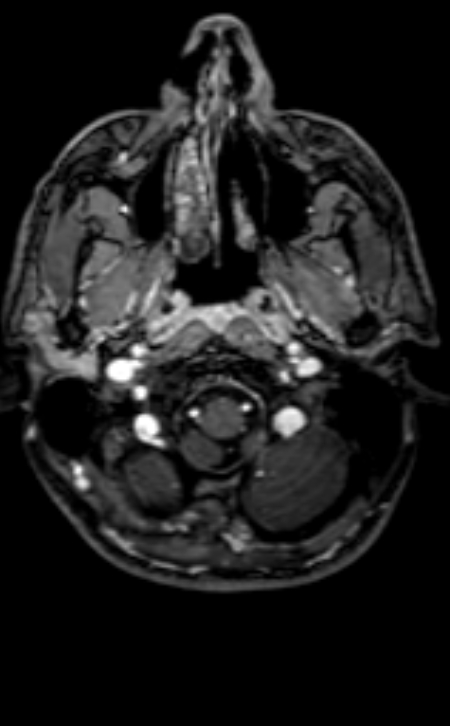 Neuro-Behçet disease (Radiopaedia 90112-107294 Axial T1 C+ 193).jpg
