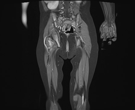 File:Neuroblastoma with bone metastases (Radiopaedia 67080-76414 E 18).jpg