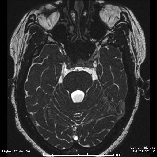 Neurocysticercosis (Radiopaedia 58636-65832 I 72).jpg