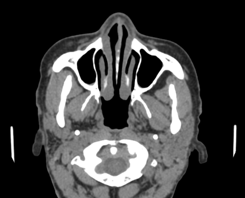 Neurofibromatosis type 1- orbital manifestations (Radiopaedia 49391-54511 Axial non-contrast 22).jpg