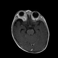 File:Neurofibromatosis type 1 (Radiopaedia 30089-30671 Axial T1 C+ 9).jpg