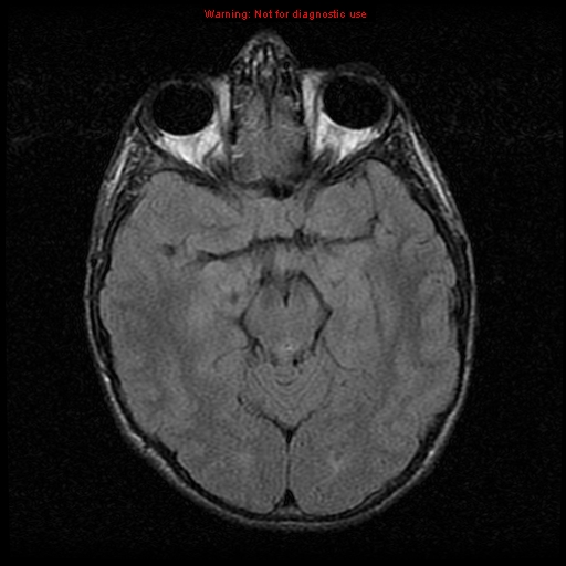 File:Neurofibromatosis type 2 (Radiopaedia 8953-9730 Axial FLAIR 11).jpg