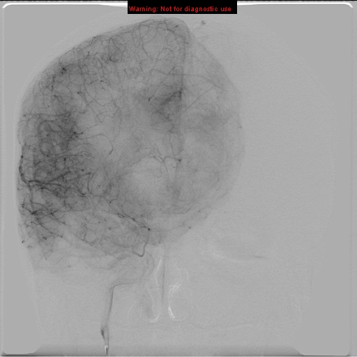 File:Neurofibromatosis type 2 (Radiopaedia 8953-9733 D 14).jpg