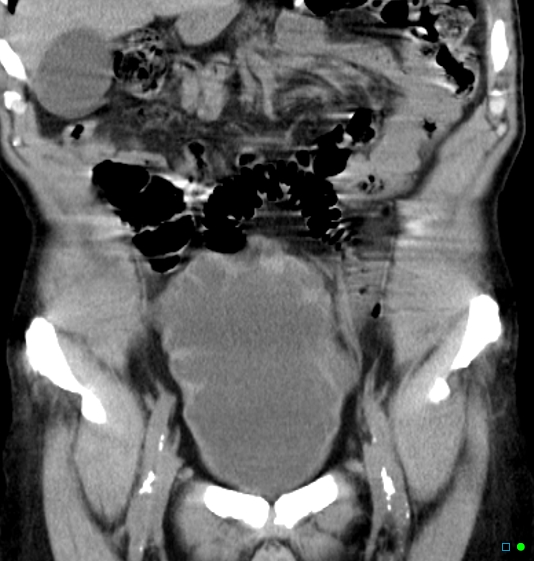 File:Neurogenic bladder - CT findings (Christmas tree bladder) (Radiopaedia 26995-27174 Coronal non-contrast 2).jpg