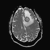 File:Neurotoxoplasmosis - concentric target sign (Radiopaedia 70644-80784 Axial ADC 15).jpg