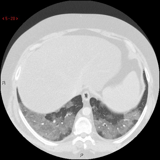 File:Non-specific interstitial pneumonitis (Radiopaedia 27044-27222 Axial lung window 11).jpg