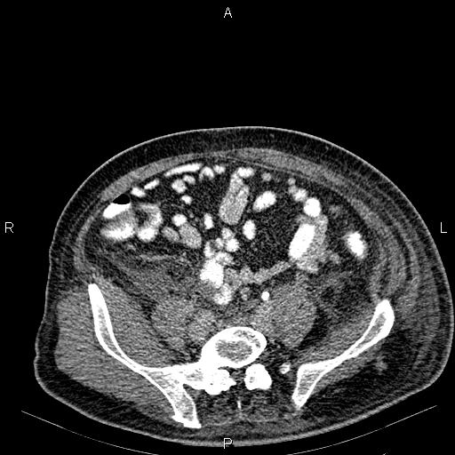 Non Hodgkin lymphoma in a patient with ankylosing spondylitis (Radiopaedia 84323-99621 Axial C+ delayed 55).jpg