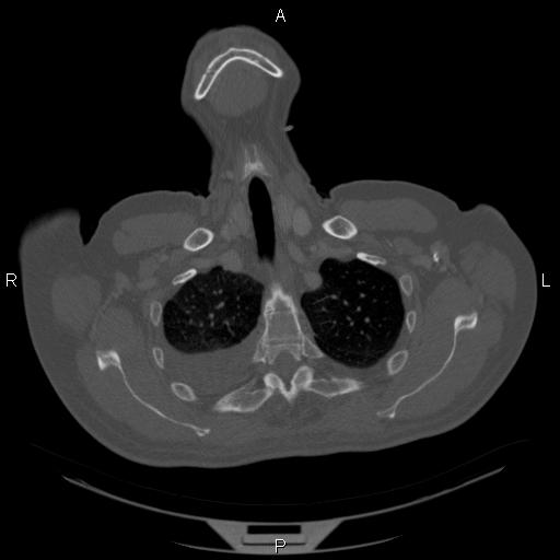 Non Hodgkin lymphoma in a patient with ankylosing spondylitis (Radiopaedia 84323-99624 Axial bone window 6).jpg