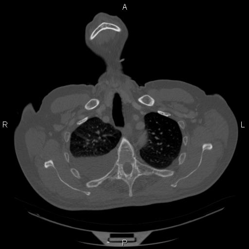 Non Hodgkin lymphoma in a patient with ankylosing spondylitis (Radiopaedia 84323-99624 Axial bone window 7).jpg