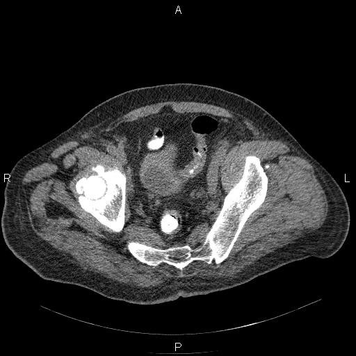 File:Non Hodgkin lymphoma in a patient with ankylosing spondylitis (Radiopaedia 84323-99624 Axial non-contrast 59).jpg