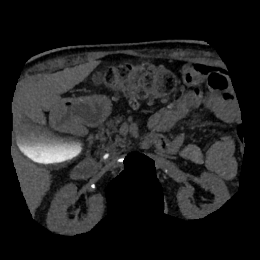 File:Normal CT intravenous cholangiogram (Radiopaedia 38199-40208 Axial IVC (MIP) 28).png