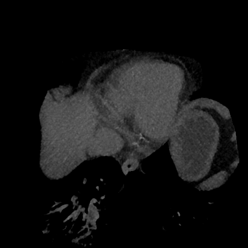 File:Normal CT intravenous cholangiogram (Radiopaedia 38199-40208 Axial IVC (MIP) 90).png