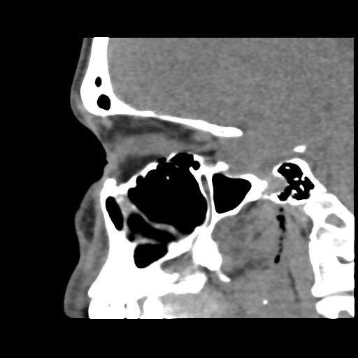 Normal CT paranasal sinuses (Radiopaedia 42286-45390 F 60).jpg