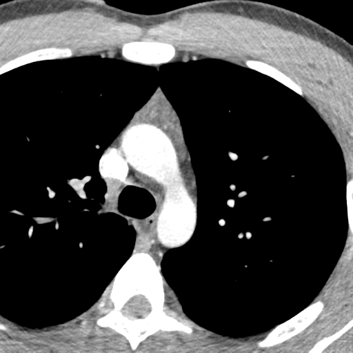 File:Normal CT pulmonary veins (pre RF ablation) (Radiopaedia 41748-44702 A 17).png