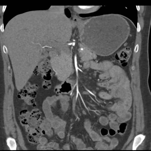 File:Normal CT renal artery angiogram (Radiopaedia 38727-40889 B 33).png