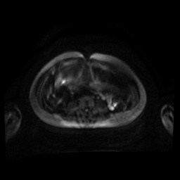 Normal MRI abdomen in pregnancy (Radiopaedia 88001-104541 Axial DWI 66).jpg
