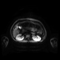 Normal MRI abdomen in pregnancy (Radiopaedia 88001-104541 Axial DWI 78).jpg