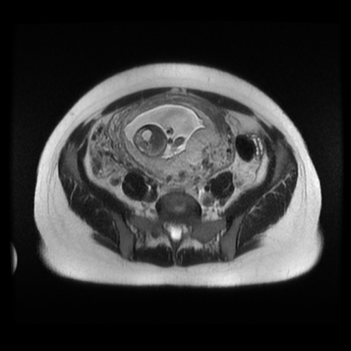 Normal MRI abdomen in pregnancy (Radiopaedia 88003-104546 Axial T2 31).jpg
