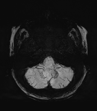 Normal MRI internal auditory canal (Radiopaedia 41613-44525 Axial SWI MIP 13).png