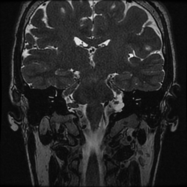 Normal MRI petrous (Radiopaedia 91317-108949 Coronal T2 59).jpg