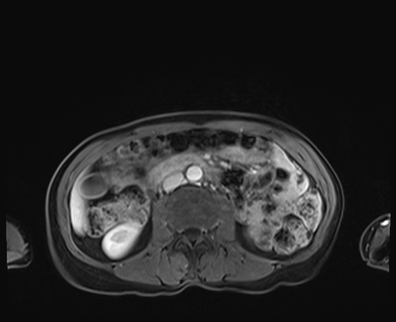Normal adrenal glands MRI (Radiopaedia 82017-96004 K 50).jpg