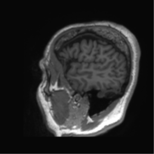 Normal brain MRI (non-focal epilepsy protocol) (Radiopaedia 53917-60040 Sagittal T1 5).png