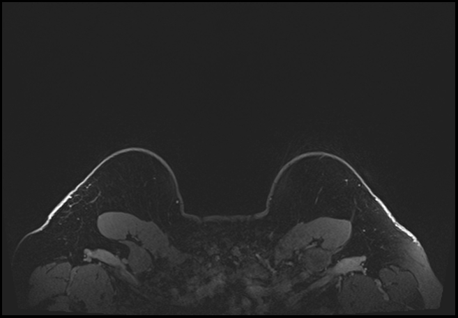 Normal breast MRI - dense breasts (Radiopaedia 80454-93850 C 220).jpg