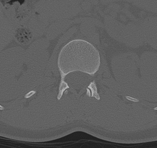 File:Normal lumbar spine CT (Radiopaedia 46533-50986 Axial bone window 8).png