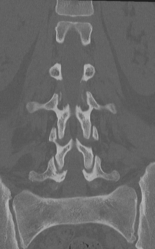 Normal lumbar spine CT (Radiopaedia 46533-50986 Coronal bone window 43).png