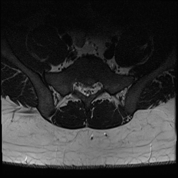 File:Normal lumbar spine MRI (Radiopaedia 47857-52609 Axial T2 31).jpg
