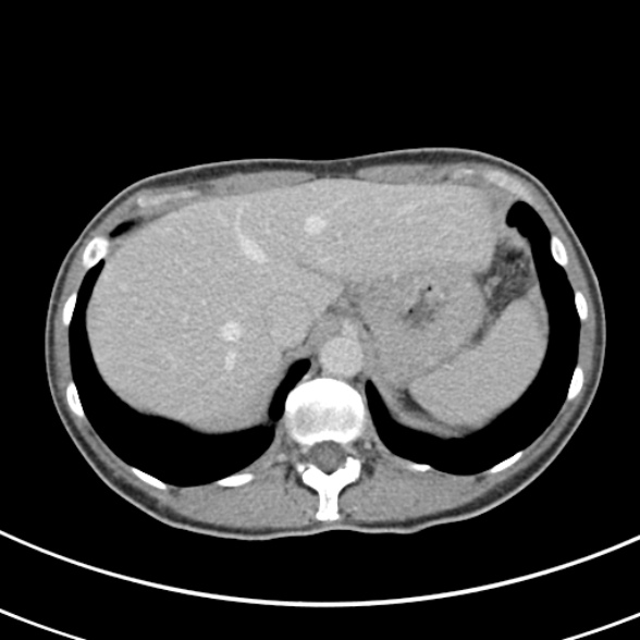 File:Normal multiphase CT liver (Radiopaedia 38026-39996 C 12).jpg