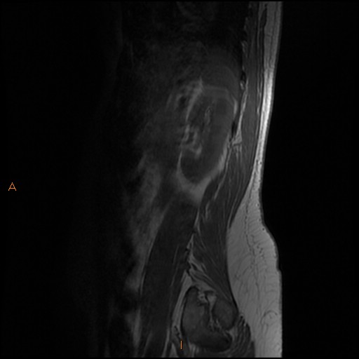 File:Normal spine MRI (Radiopaedia 77323-89408 Sagittal T1 15).jpg