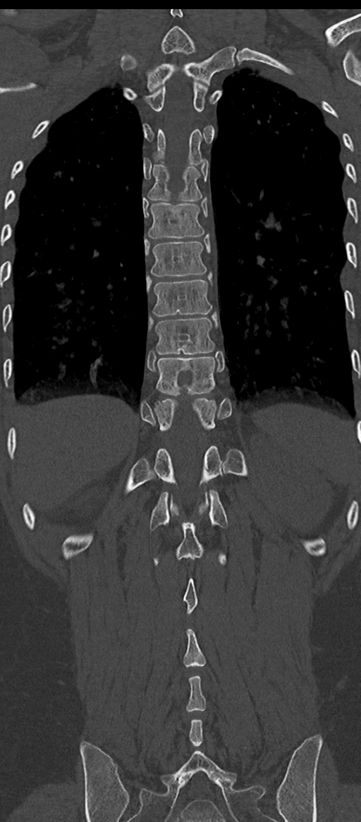 Normal thoracolumbar spine (Radiopaedia 43822-47309 Coronal bone window 65).png
