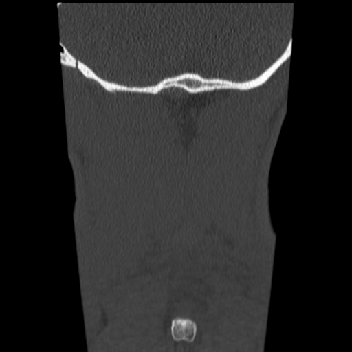 File:Normal trauma cervical spine (Radiopaedia 41017-43760 Coronal bone window 49).png