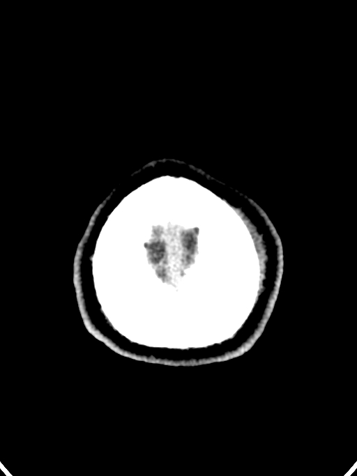Normal trauma protocol brain and C-spine CT (Radiopaedia 83302-97709 Axial non-contrast 9).jpg