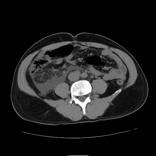 File:Obstructed kidney with perinephric urinoma (Radiopaedia 26889-27066 Axial non-contrast 37).jpg