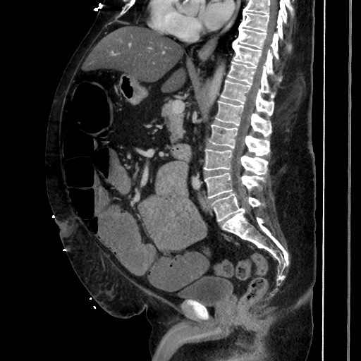 Obstructive colonic diverticular stricture (Radiopaedia 81085-94675 C 124).jpg