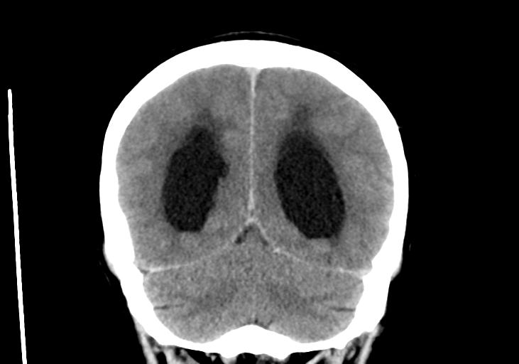 File:Obstructive hydrocephalus (Radiopaedia 30453-31119 Coronal non-contrast 30).jpg